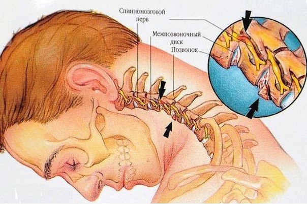 vosem uprajnenii protiv sheinogo osteohondroza Восемь упражнений против шейного остеохондроза