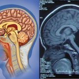 Девушка 24 года жила без важного отдела головного мозга